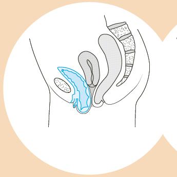 Cystocèle