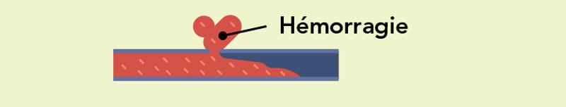 AVC hémorragique