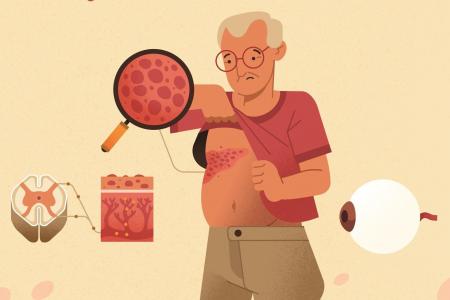 illustration : Le zona