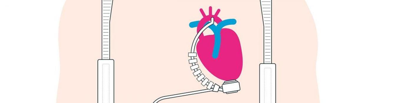 insuffisance cardiaque