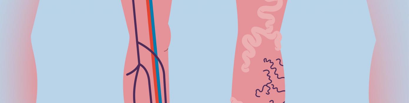 varices