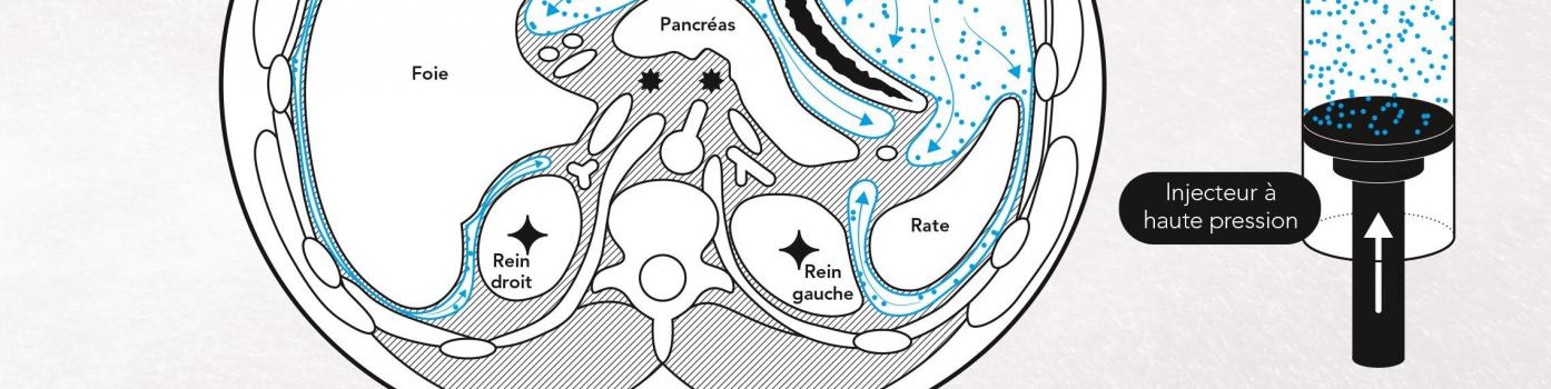 Schéma explicatif de la chimiothérapie par aérosol