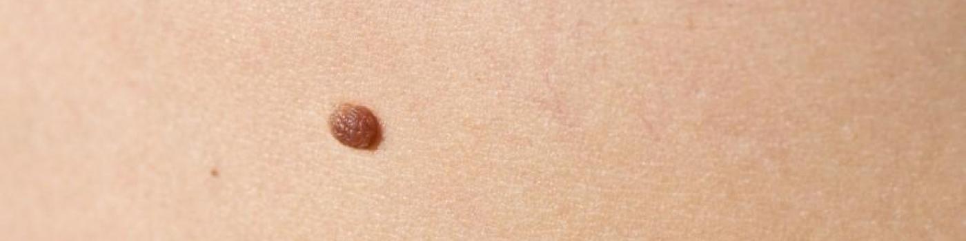 Un grain de beauté sur la peau