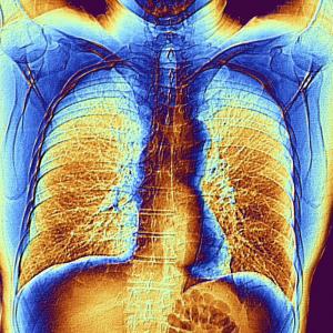 Pneumonie mieux détectée