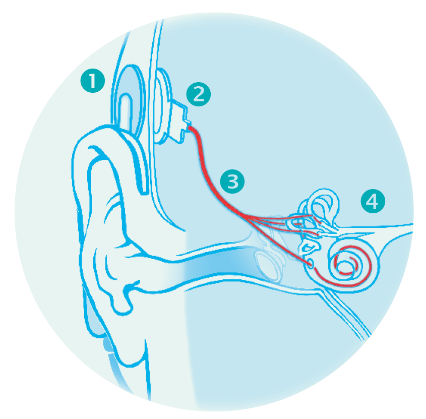 neuroprothèse neuroprothèse